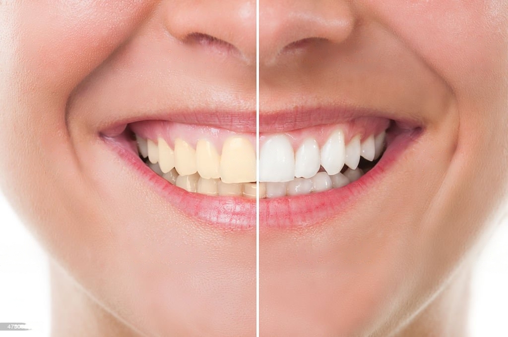 Smile Makeovers with Clear Aligners