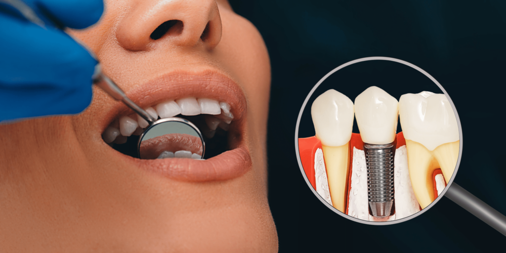 Dental Implants