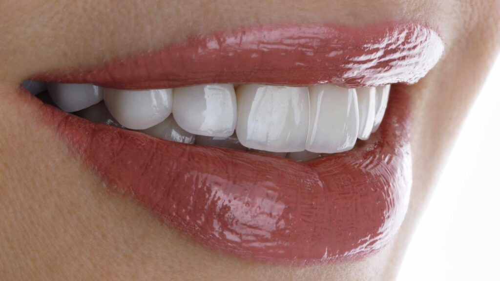 Veneers on Your Smile
