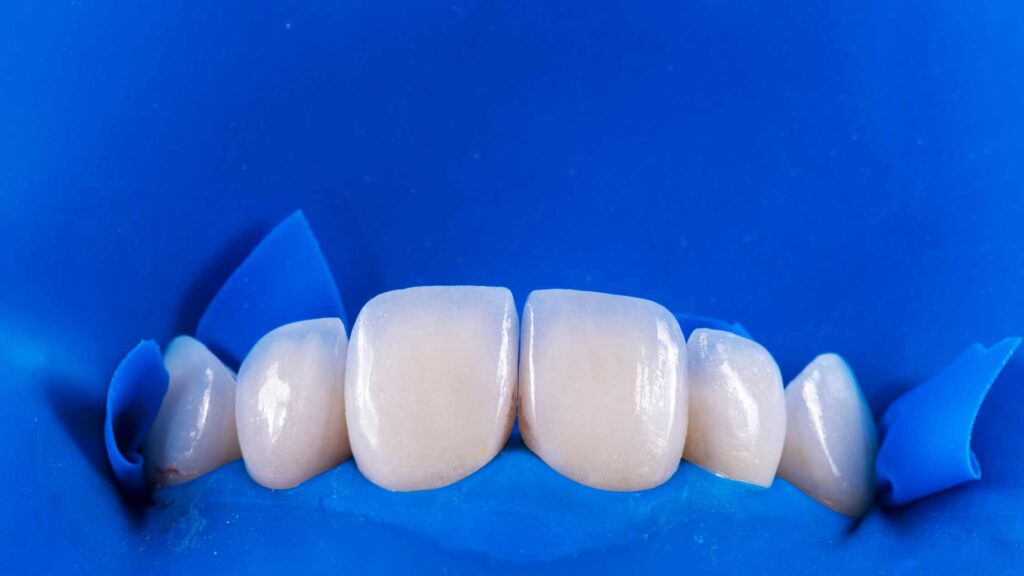 Porcelain Veneers