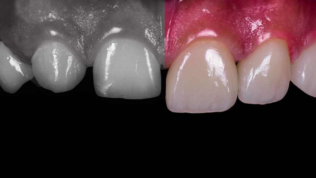 Process Veneers