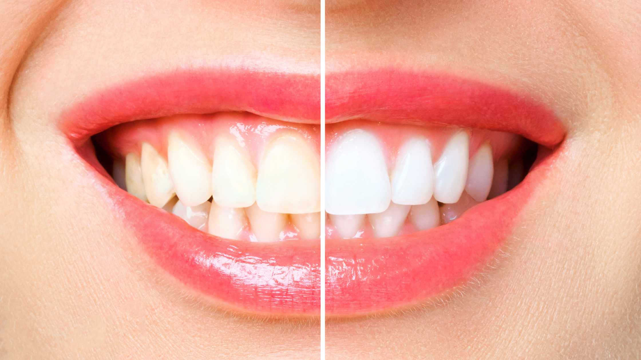 Teeth Whitening Treatment in Cleveland