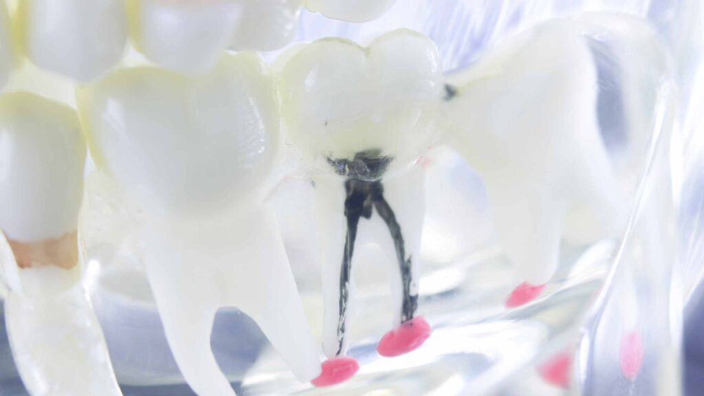 Root Canal Facts Unplugged Exposing Myths for What They Are