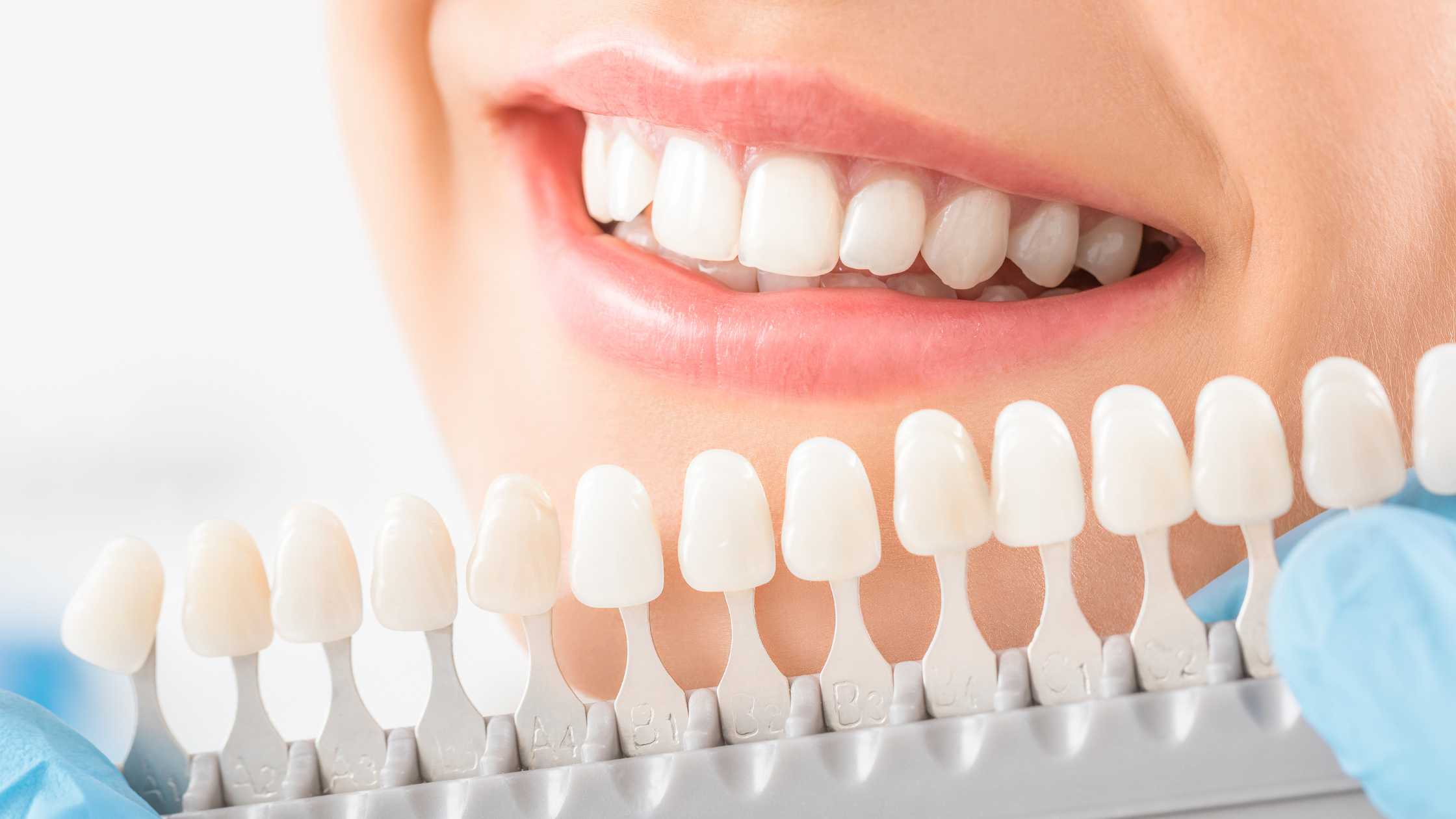 teeth whitening services