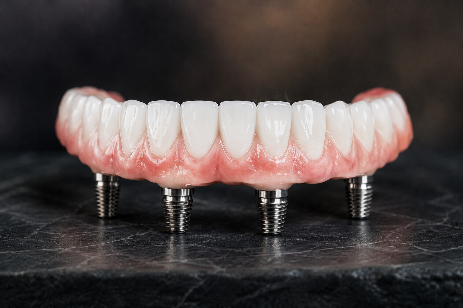 All-On-4 dental implants full arch smile restoration
