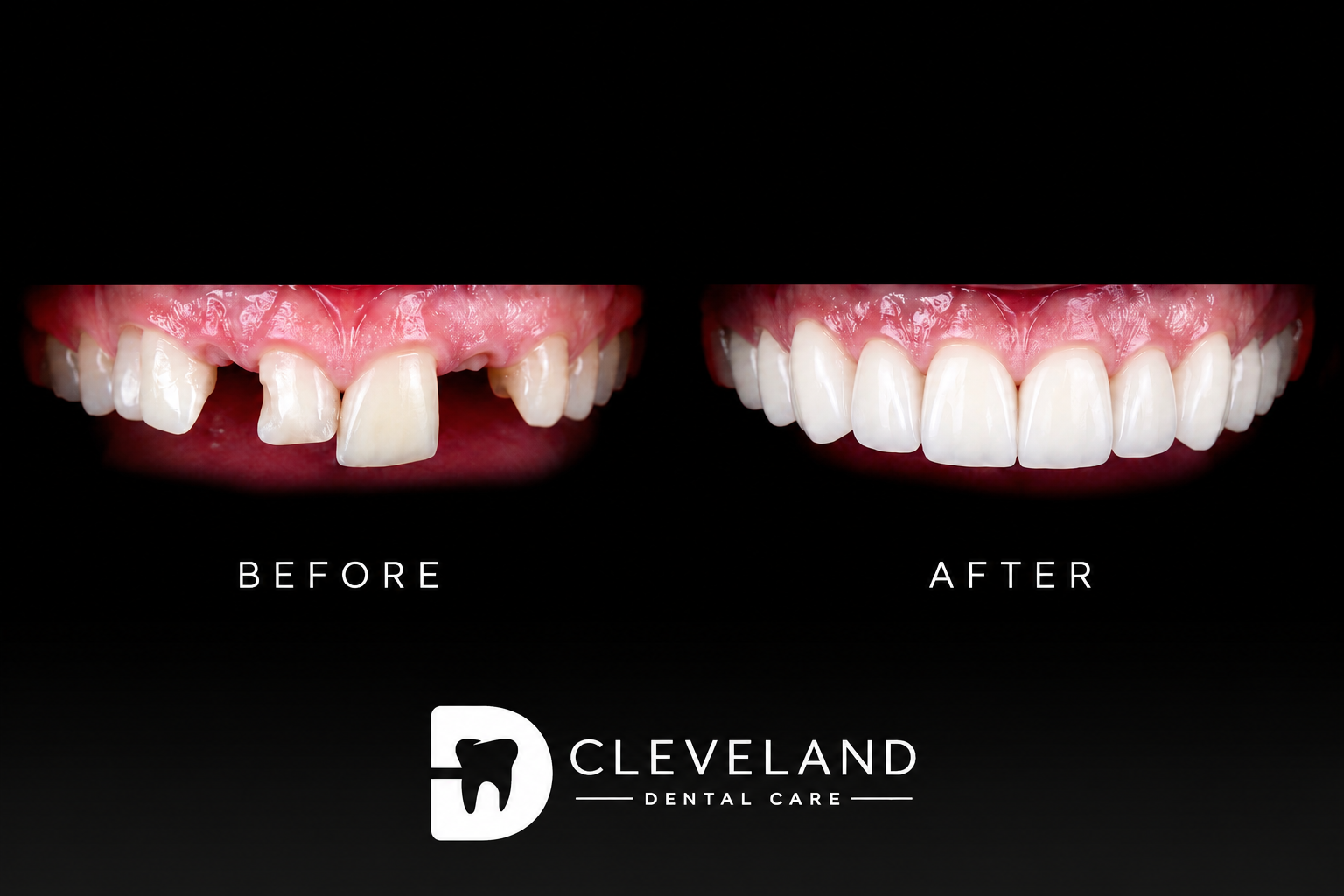 Patient smiling after dental implant treatment in Cleveland